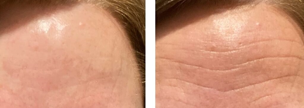 what are the best forehead wrinkle patches​?