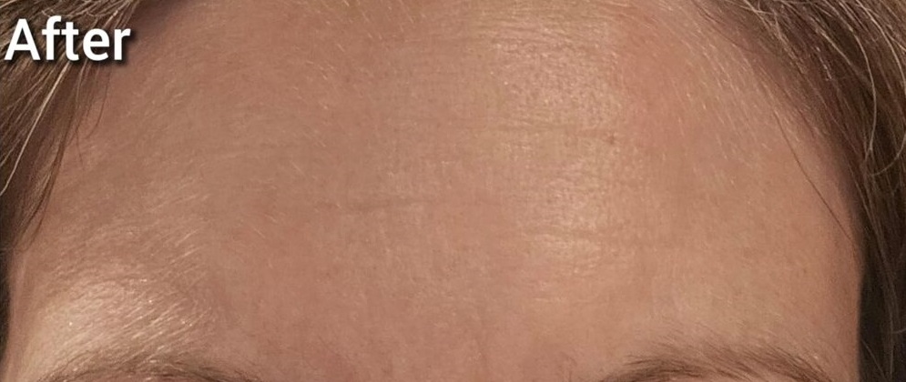 Do forehead wrinkle patches work?