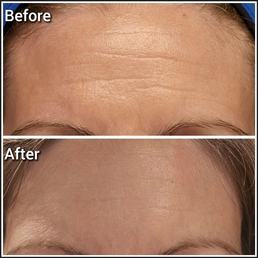 Forehead Wrinkle Patches